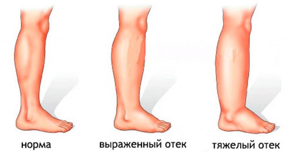 лечение отеков ног