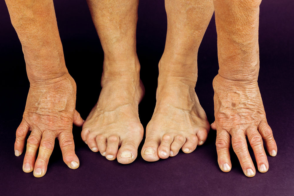 Лечение «Шишки» на большом пальце стопы или вальгусная деформация.