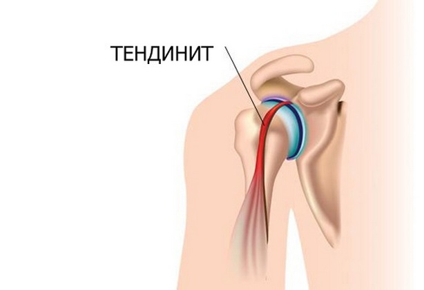 лечение тендинита плечевого сустава