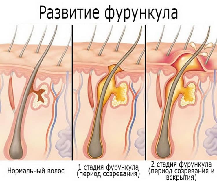 Вскрытие фурункула, абсцесса - симптомы, причины, методы лечения в МЦ  "Звезда"