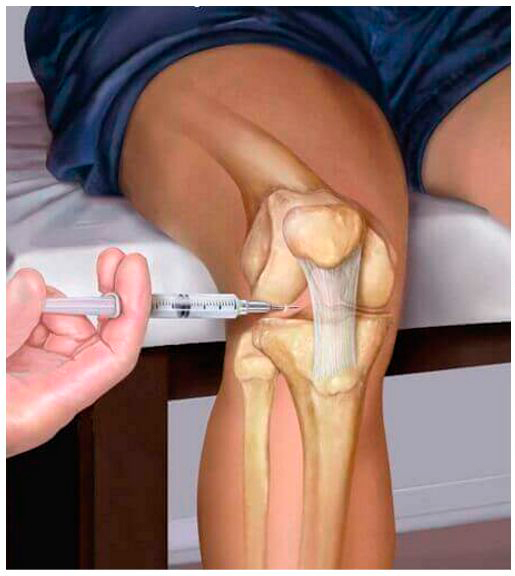 Лечебные блокады при болях в коленном суставе