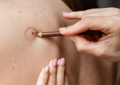 Удаление бородавок