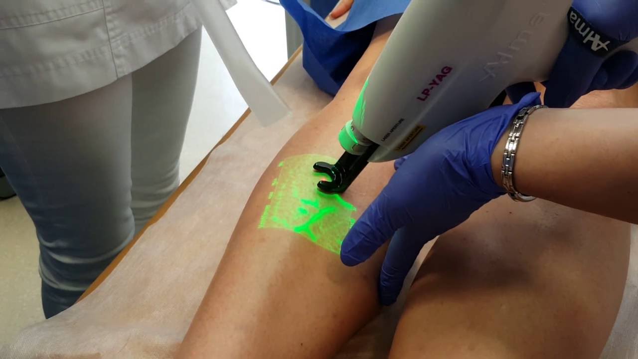 Лазерная коррекция сосудов АЛЬМА-ЛАЗЕР