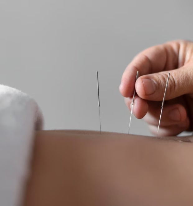 Рефлексотерапия (иглоукалывание, акупунктура)