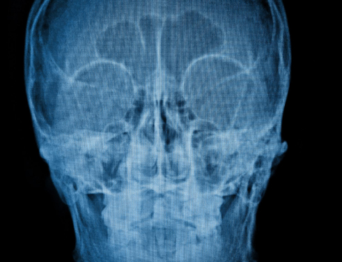 Рентген пазух носа