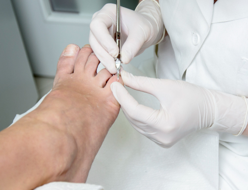 Удаление вросшего ногтя