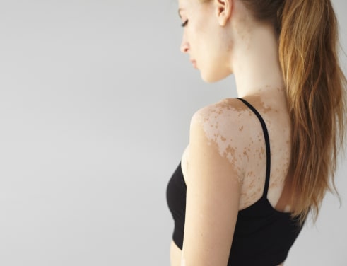 Удаление пигментных пятен